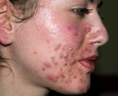 What are common causes for spots on the skin?