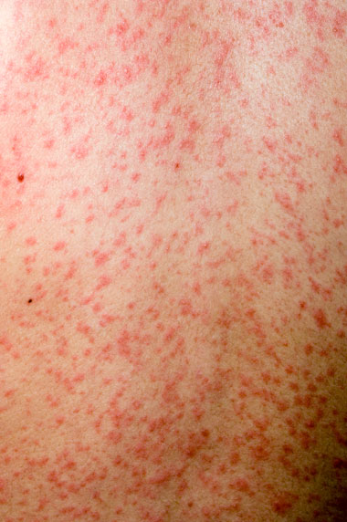 Adult Measles Rash 67