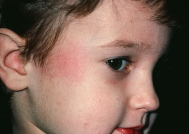 NHS Direct Wales - Encyclopaedia : Skin rashes in children